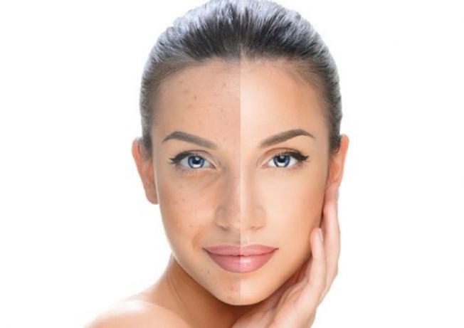 can-skin-pigmentation-be-removed