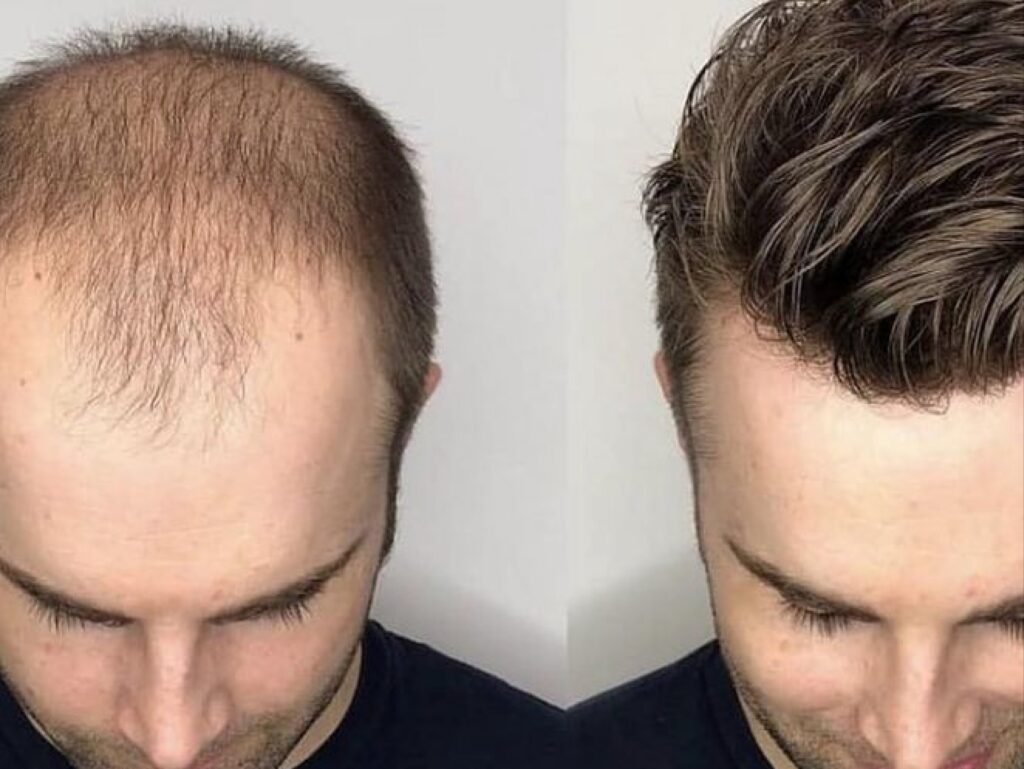 before-after-gfc-treatment