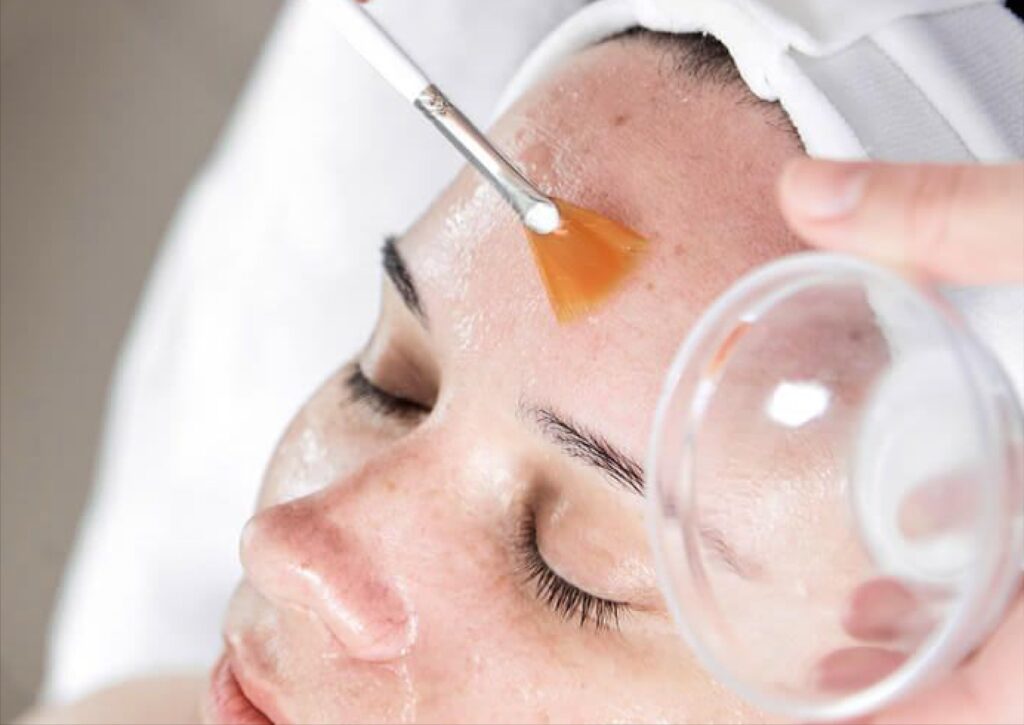 chemical peel